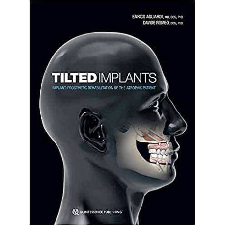 TILTED IMPLANTS IMPLANT-PROSTHETIC REHABILITATION OF THE ATROPHIC PATIENT