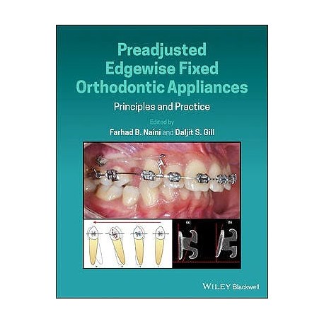 PREADJUNSTED EDGEWISE FIXED ORTHODONTIC APPLIANCES. PRINCIPLES AND PRACTICE