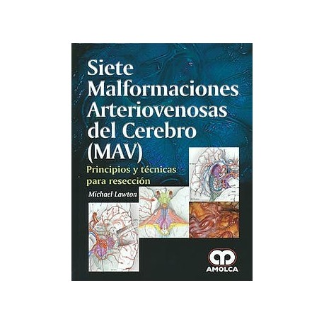 SIETE MALFORMACIONES ARTERIOVENOSAS DEL CEREBRO (MAV). PRINCIPIOS Y TECNICAS PARA RESECCION.