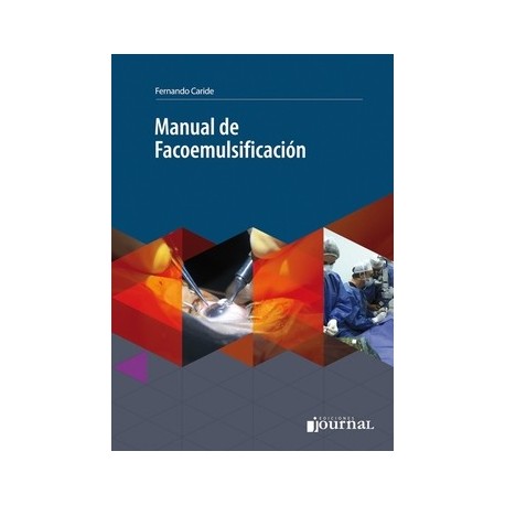 MANUAL DE FACOEMULSIFICACION + ACCESO ONLINE