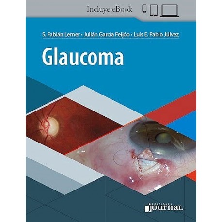GLAUCOMA (INCLUYE E-BOOK)