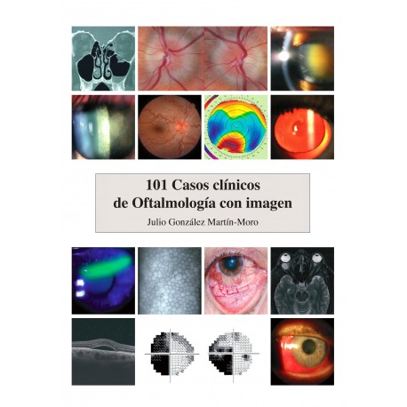 101 CASOS CLINICOS DE OFTALLMOLOGIA CON IMAGEN