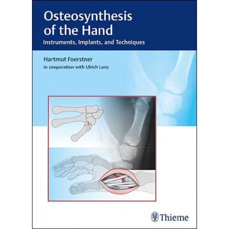 OSTEOSYNTHESIS OF THE HAND. INSTRUMENTS, IMPLANTS AND TECHNIQUES