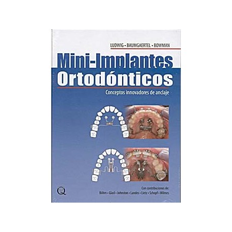 MINI-IMPLANTES ORTODONTICOS