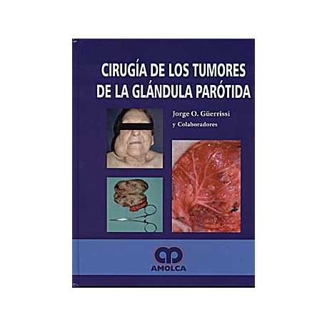 CIRUGIA DE LOS TUMORES DE LA GLANDULA PAROTIDA