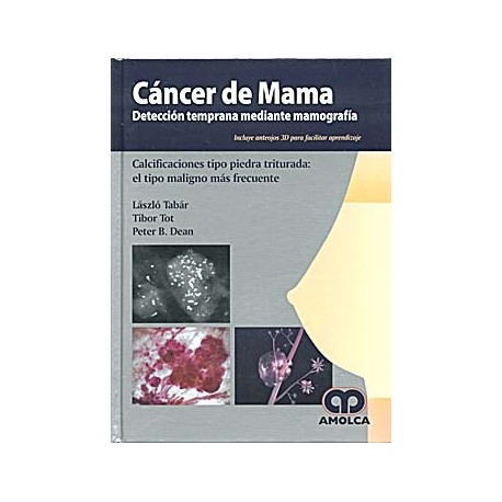 CANCER DE MAMA Â¬  DETECCION TEMPRANA MEDIANTE MAMOGRAFIA