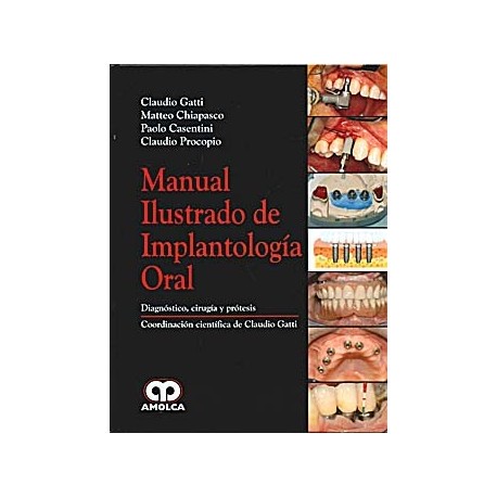 MANUAL ILUSTRADO DE IMPLANTOLOGIA ORAL. DIAGNOSTICO, CIRUGIA Y PROTESIS