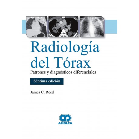 RADIOLOGIA DE TORAX. PATRONES Y DIAGNOSTICOS DIFERENCIALES