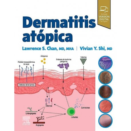 DERMATITIS ATOPICA (INCLUYE VERSION DIGITAL EN INGLES)