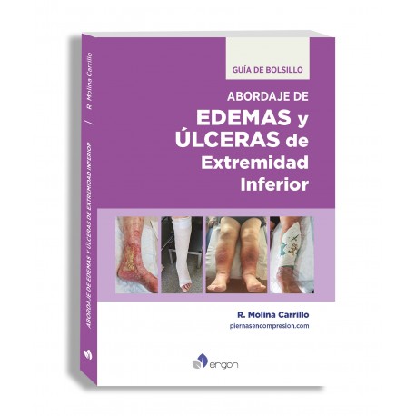 ABORDAJE DE EDEMAS Y ULCERAS DE EXTREMIDAD INFERIOR. GUIA DE BOLSILLO