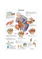 ARTROSIS (VR-3123)