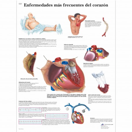 ENFERMEDADES MAS FRECUENTES DEL CORAZON (VR-3343)