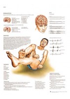 EPILEPSIA (VR-3626)