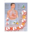 ESOFAGITIS POR REFLUJO (VR-3711)