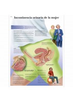 INCONTINENCIA URINARIA DE LA MUJER (VR-3542)