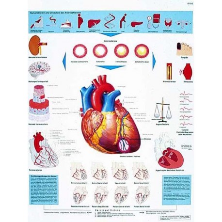 INFARTO DE MIOCARDIO (VR-3342)