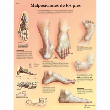 MALPOSICIONES DE LOS PIES (VR-3185)