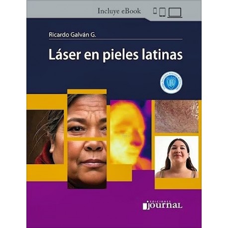 LASER EN PIELES LATINAS