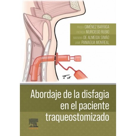 ABORDAJE DE LA DISFAGIA EN EL PACIENTE TRAQUEOSTOMOTIZADO