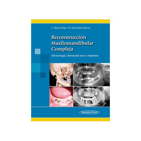 RECONSTRUCCION MAXILOMANDIBULAR COMPLEJA