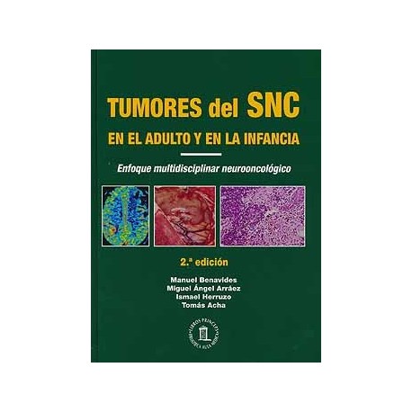 TUMORES DEL SNC EN EL ADULTO Y EN LA INFANCIA