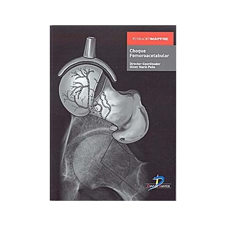 CHOQUE FEMOROACETABULAR