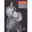 CHOQUE FEMOROACETABULAR