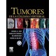 TUMORES DE LA COLUMNA VERTEBRAL