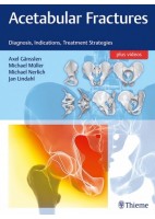 ACETABULAR FRACTURES. DIAGNOSIS, INDICATIONS, TREATMENT STRATEGIES
