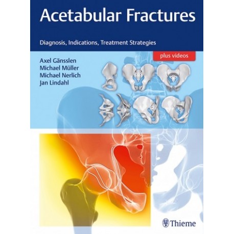 ACETABULAR FRACTURES. DIAGNOSIS, INDICATIONS, TREATMENT STRATEGIES