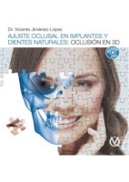 AJUSTE OCLUSAL EN IMPLANTES Y DIENTES NATURALES