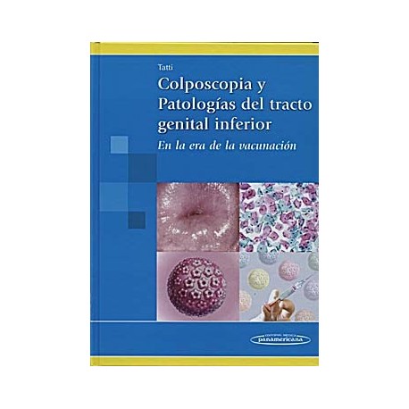 COLPOSCOPIA Y PATOLOGIAS DEL TRACTO GENITAL INFERIOR