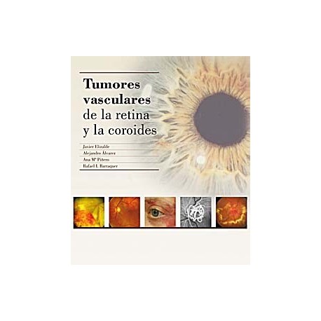 TUMORES VASCULARES DE LA RETINA Y DE LA COROIDES