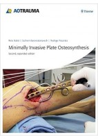 MINIMALLY INVASIVE PLATE OSTEOSYNTHESIS (MIPO)