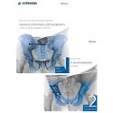 FRACTURES OF THE PELVIS AND ACETABULUM (2 VOL.)