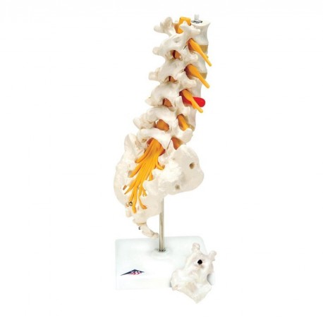 MODELO COLUMNA VERTEBRAL LUMBAR CON HERNIA DISCAL DORSOLATERAL